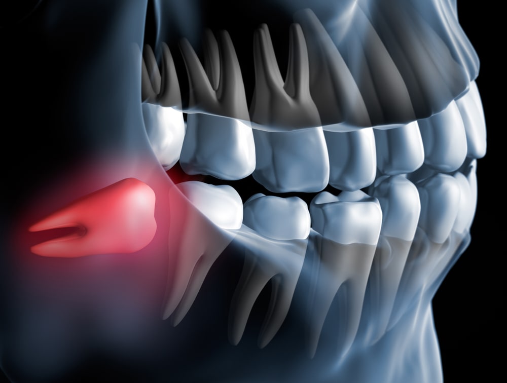 Extraction des Dents de Sagesse, Ce qu'il faut Savoir -