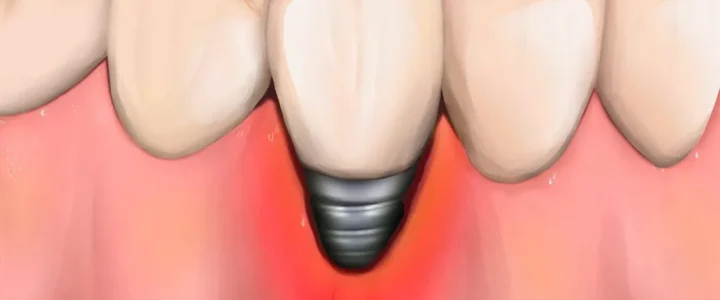 Péri-implantite : Causes, Symptômes et Traitements