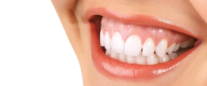 Quelles solutions pour embellir un sourire gingival ?