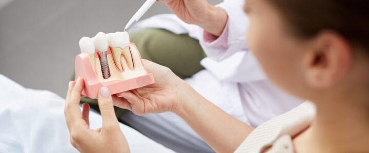 Quel est le temps de cicatrisation d’un implant dentaire ?