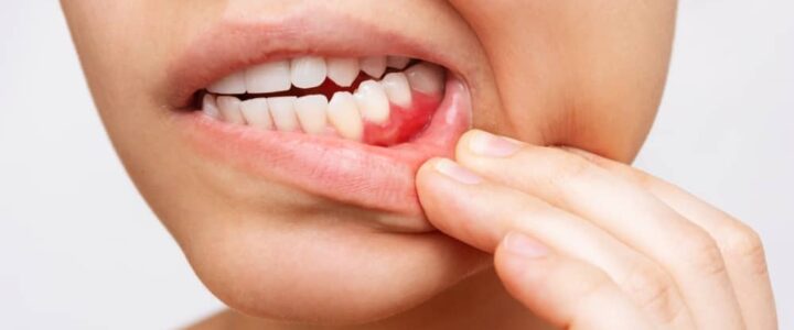Rejet d’un Implant Dentaire : Causes et Symptômes