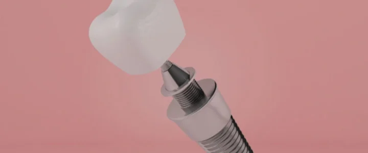 Dent sur pivot : tout savoir sur ce soin et sa durée de vie