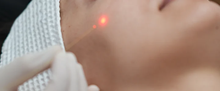 Endolift : le traitement révolutionnaire du relâchement cutané sans chirurgie