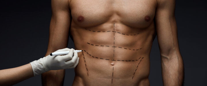 U-Graft en Tunisie avec le Dr Youssef Gam : La solution naturelle pour des abdos sculptés et des muscles plus volumineux