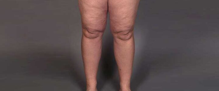 Récupération rapide après chirurgie du lipœdème : L’approche inspirée du protocole ERAS Récupération rapide après chirurgie du lipœdème : L’approche inspirée du protocole ERAS