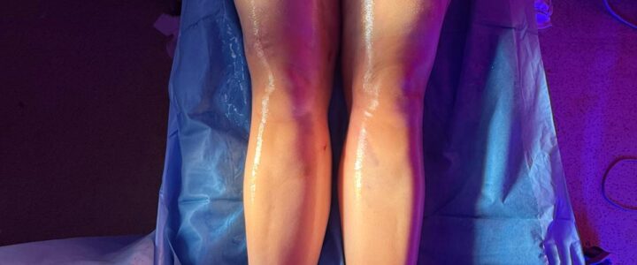 Chirurgie du lipœdème et « 4D Lipo » : comprendre les différences entre approche médicale et concept marketing Chirurgie du lipœdème et « 4D Lipo » : comprendre les différences entre approche médicale et concept marketing