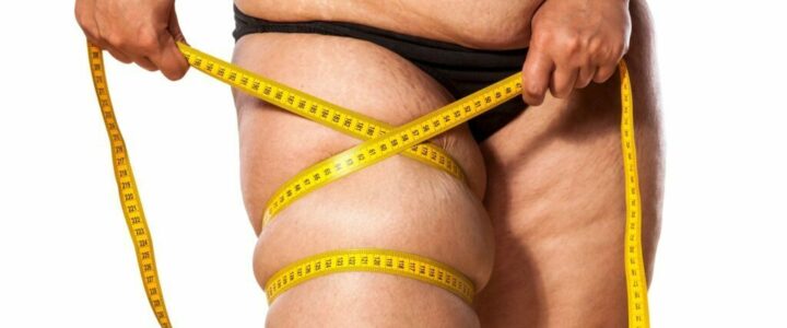 Lipœdème ou obésité : comment faire la différence ?