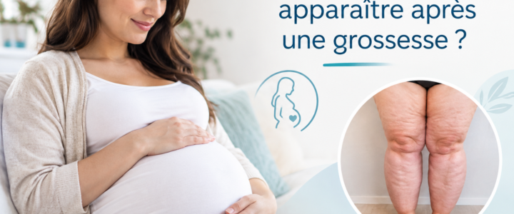 Le lipœdème peut-il apparaître après une grossesse ?