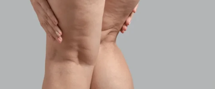 Dr Gam : une expertise internationale du lipœdème enrichie par une expérience en Colombie Dr Gam : une expertise internationale du lipœdème enrichie par une expérience en Colombie